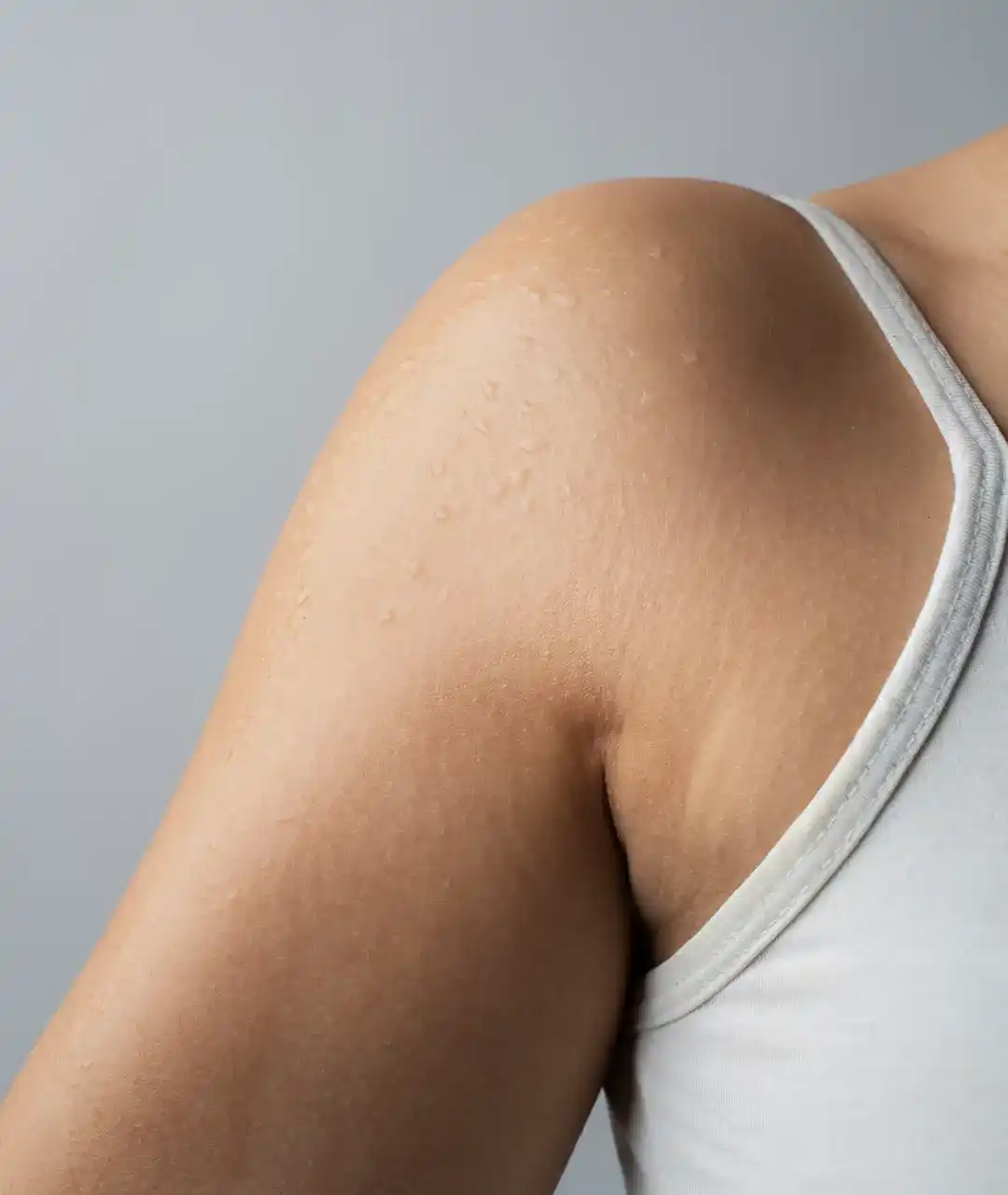 ayurvedic products for stretch mark