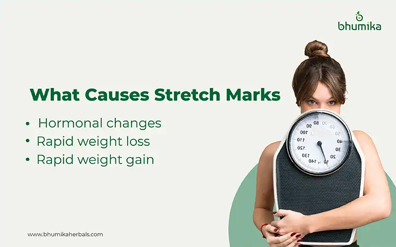 what causes stretch marks